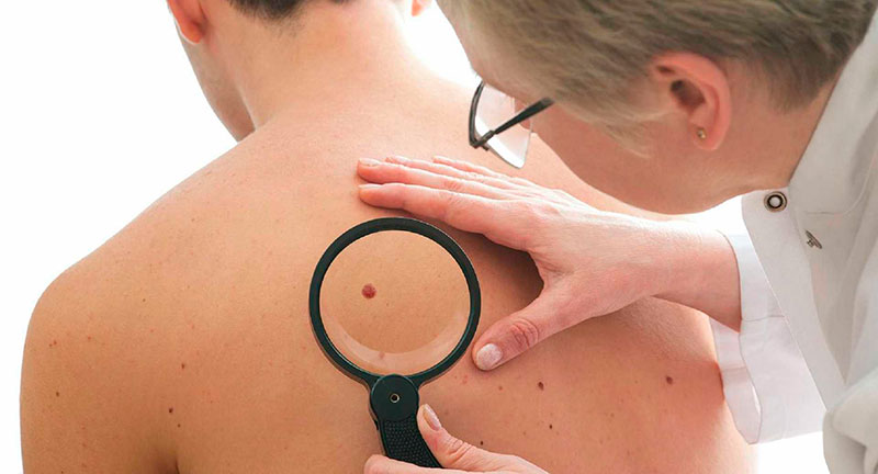 В 2019 году в Могилевской области выявлено 983 случая рака кожи