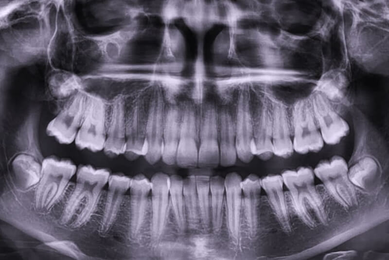 3d снимок зубов — информация о процедуре