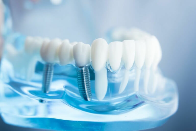 Современные решения в стоматологии - преимущества имплантов