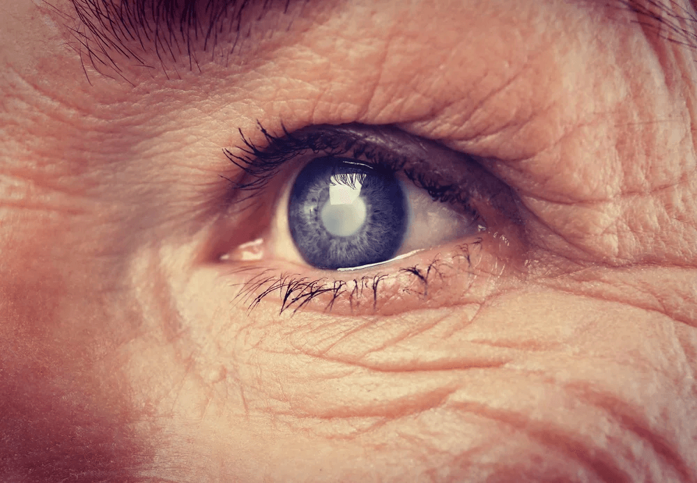 Операция по удалению катаракты в СПб у пожилых пациентов: особенности и рекомендации